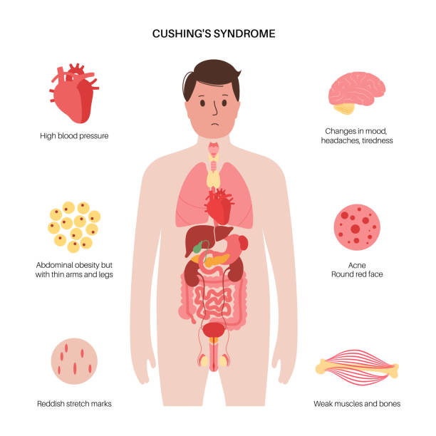 쿠싱증후군 원인
