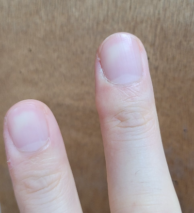 손톱 세로줄 생기는 이유