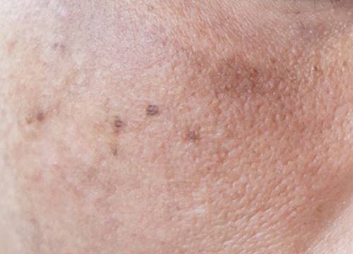 기미와 검버섯의 차이