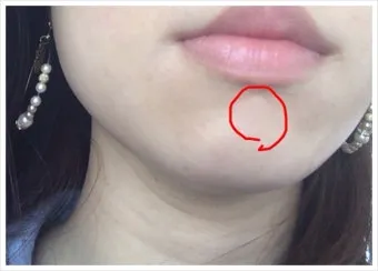 얼굴 버짐 증상 없애는 실전 방법 5가지 및 관리요령_15