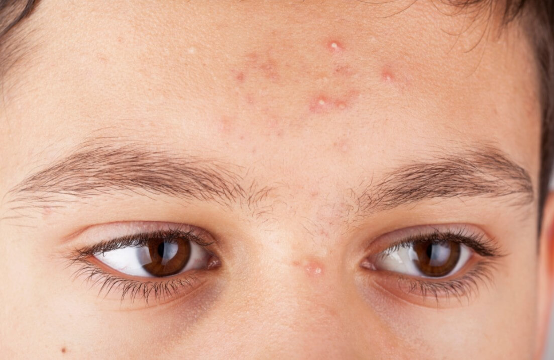 이마에 난 여드름