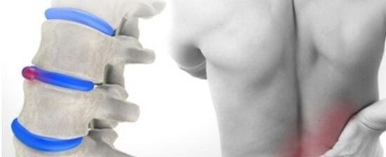 허리 삐끗했을때 파스