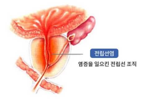전립선염 증상
