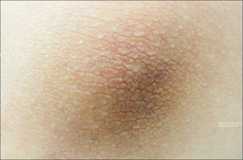 팔꿈치 착색 제거 전