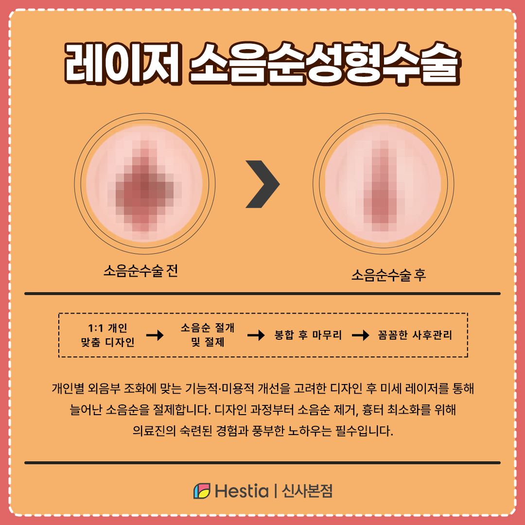 레이저 소음순성형수술
