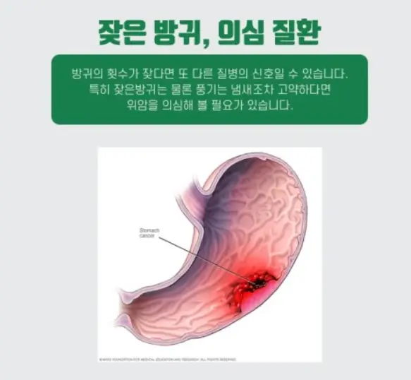 위암-원인과증상