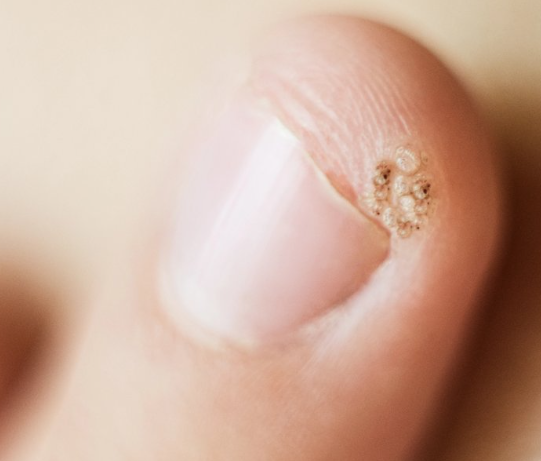 손발톱주의사마귀 사진