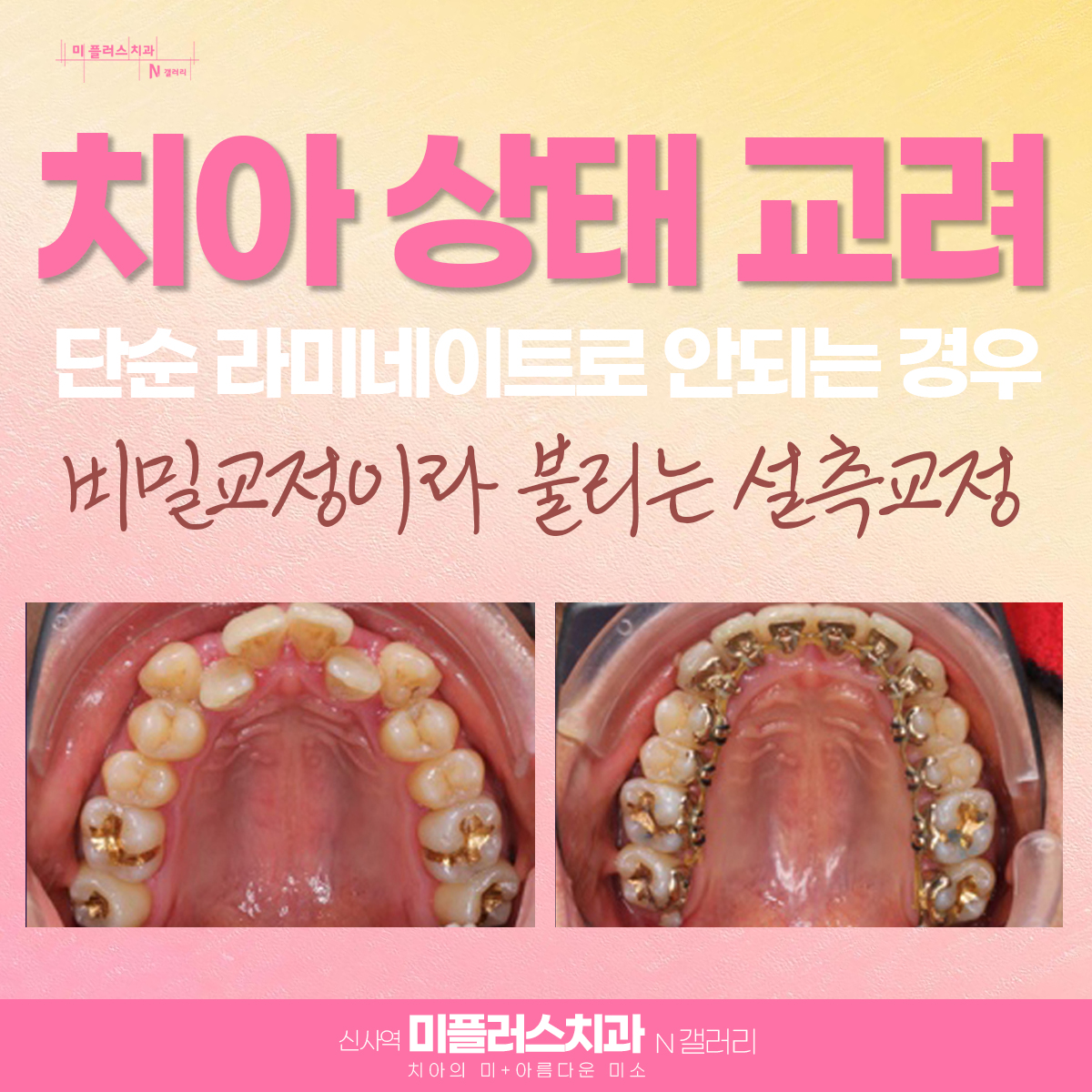 외부에서 보이지 않는 안쪽 교정을 한 설측교정 사례의 사진