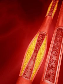 고지혈증 증상&amp;#44; 고지혈증에 좋은 음식&amp;#44; 고지혈증 수치 총정리 (2024ver)