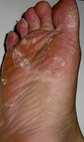 무좀에 감염 관련 사진