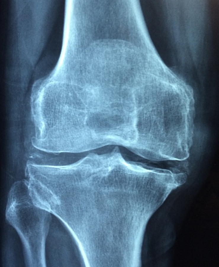 무릎-관절-사진