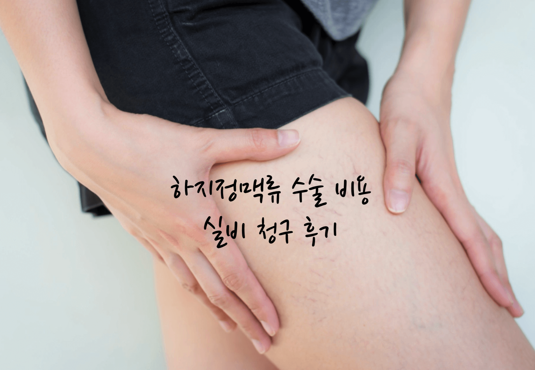 하지정맥류