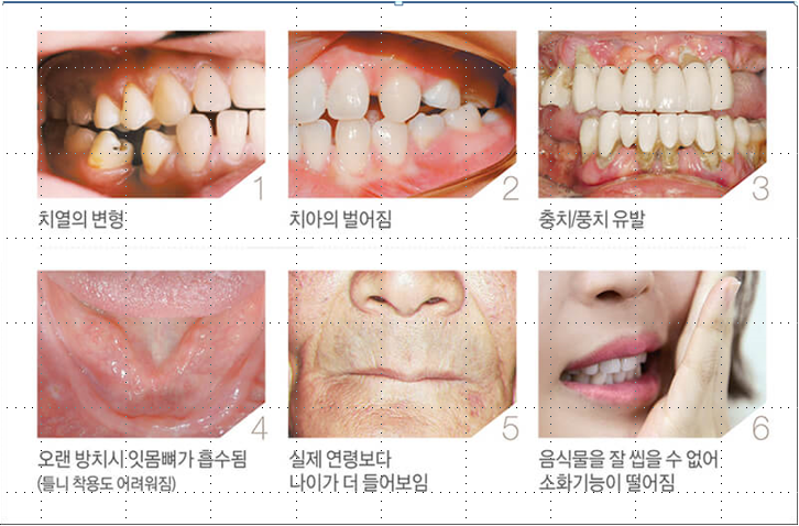 임플란트 시술