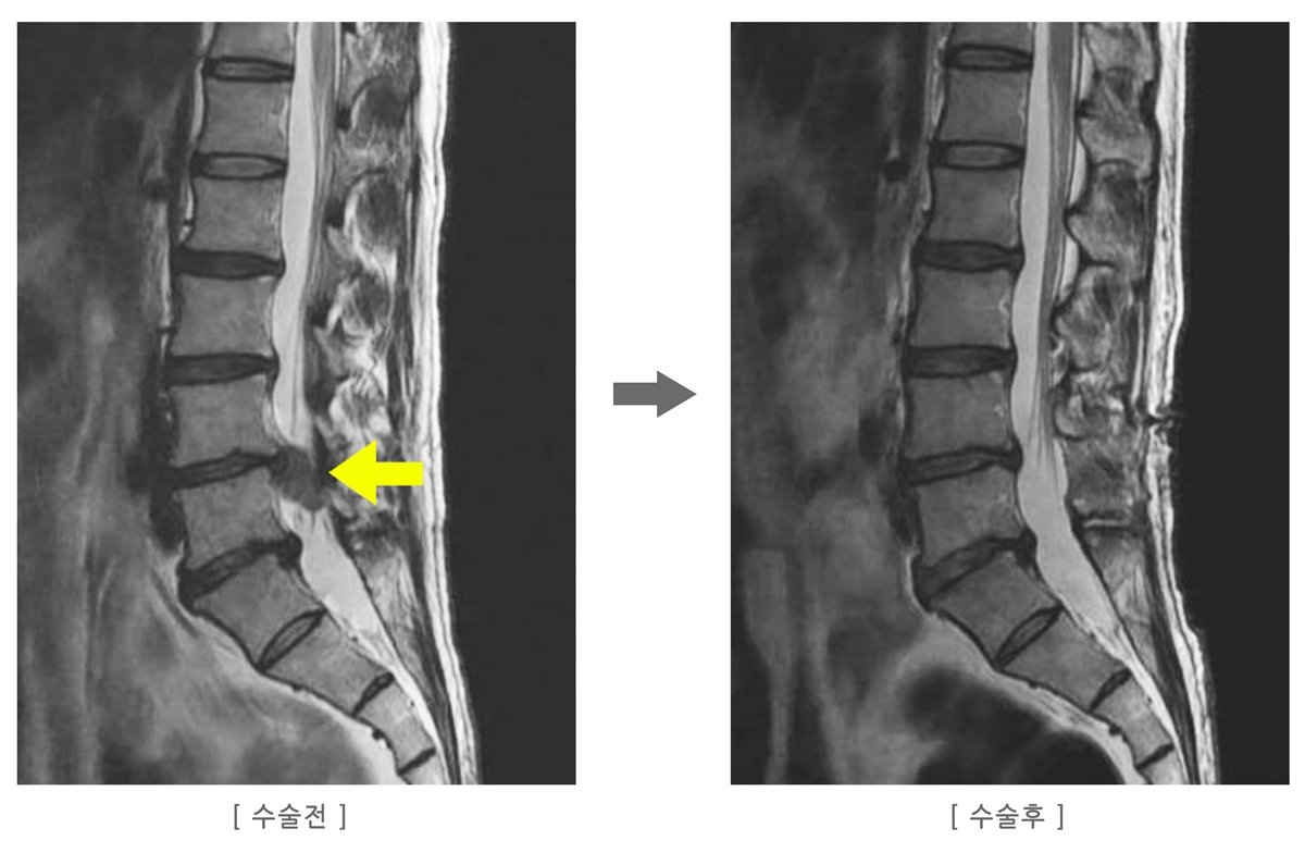 허리디스크 수술 재발률 1%라는 말&amp;#44; 정말일까?&hellip; 내가 겪은 재수술 후기와 꼭 알아야 할 진실