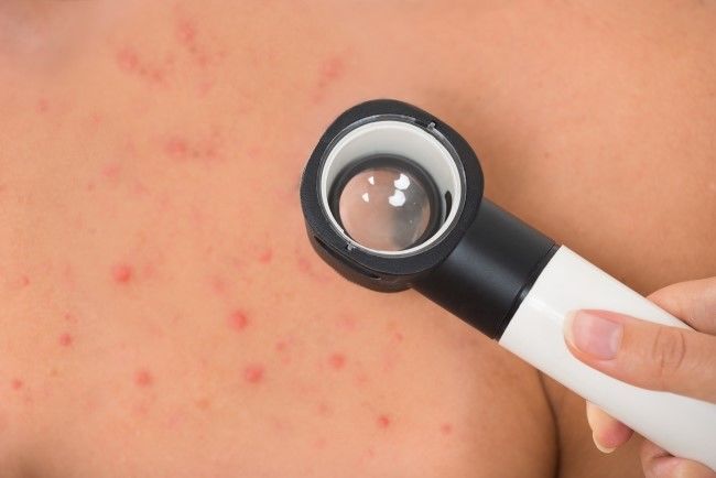 자반증 초기증상