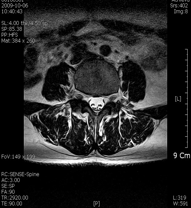 MRI