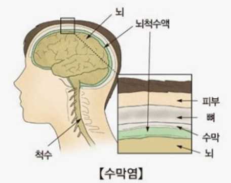 뇌수막염
