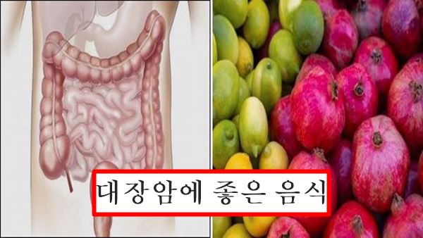 대장암에 좋은 음식