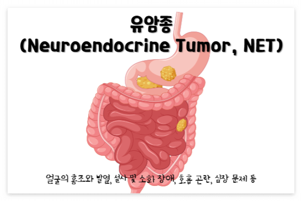 유암종(Neuroendocrine Tumor, NET)
유암종 증상 : 얼굴의 홍조와 발열, 설사 및 소화 장애, 호흡 곤란, 심장 문제 등