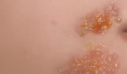 대상포진-무료접종-대상-가격-저렴한-병원-찾기-건강