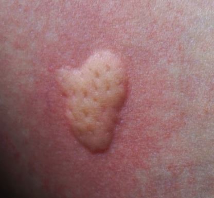 모기 스키터 증후군