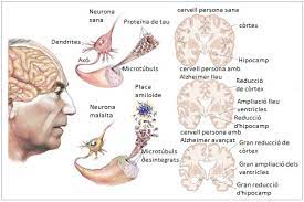 알츠하이머병의 원인과 예방