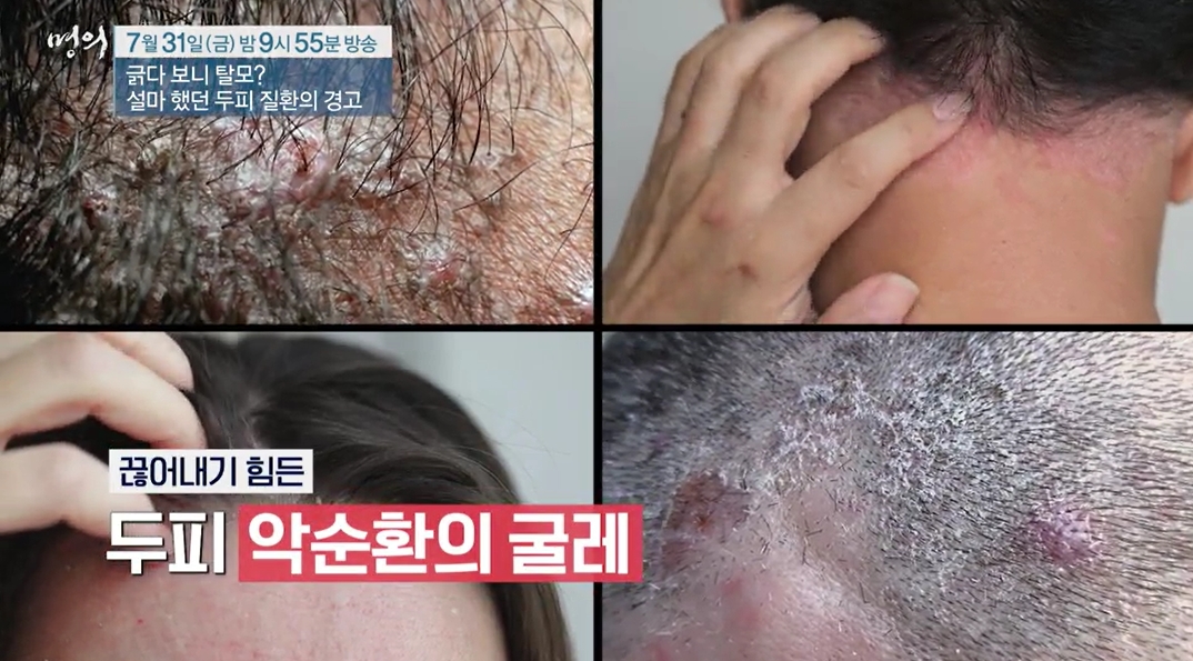 명의 두피질환