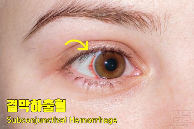 눈 실핏줄 터지는 이유 눈혈관 터짐 결막하출혈 원인