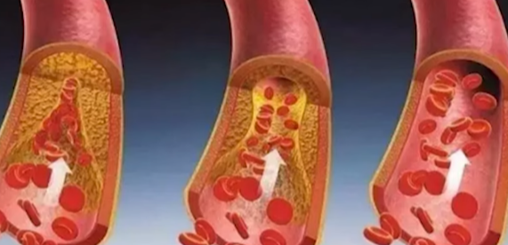 나쁜 콜레스테롤(LDL)