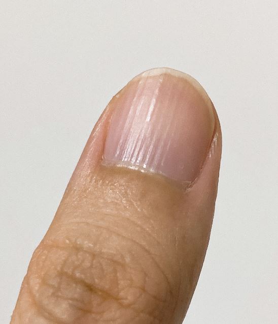 손톱 세로줄&amp;#44; 관리방법&amp;#44; 원인&amp;#44; 손톱 영양제 추천