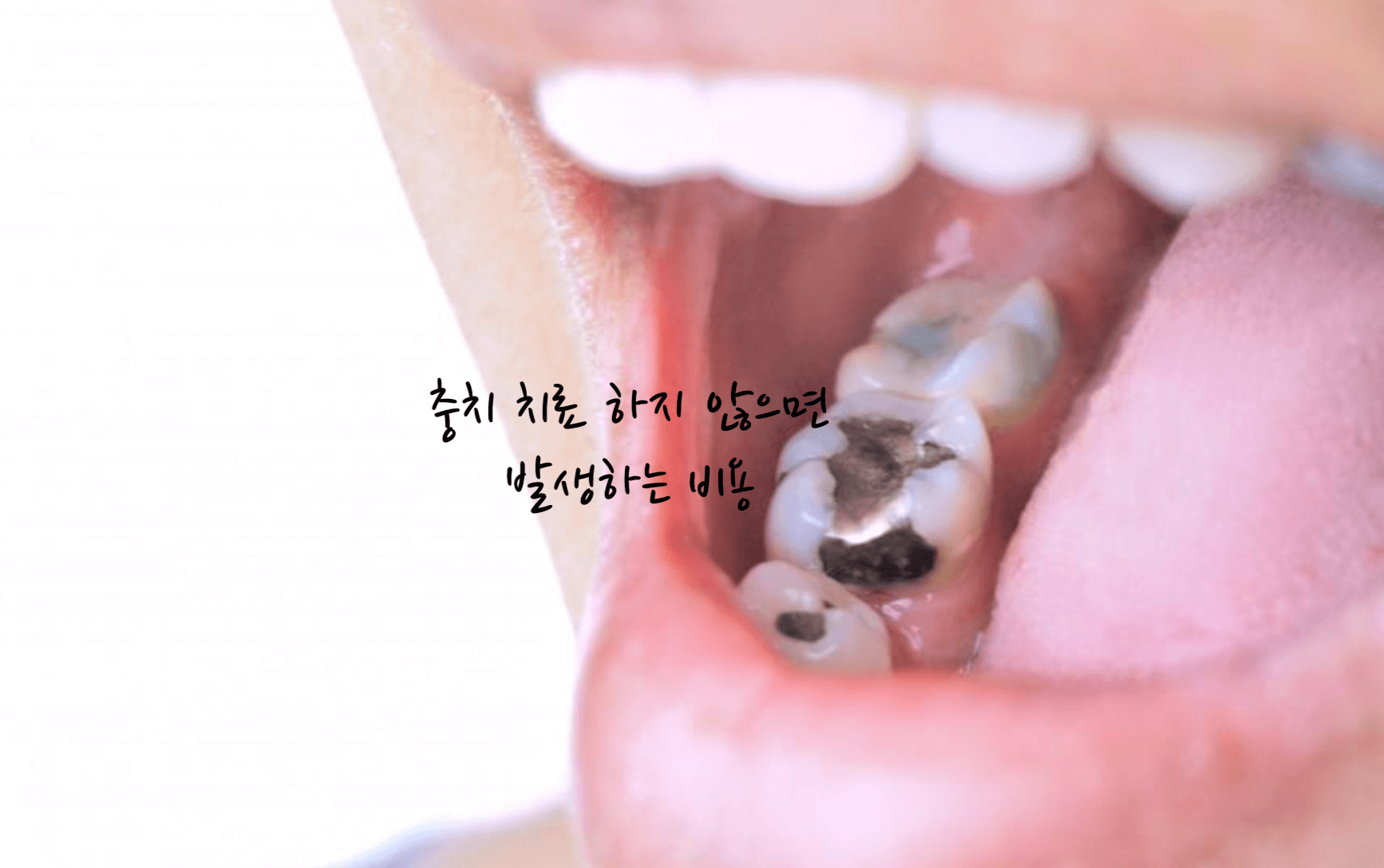 충치 치료 비용