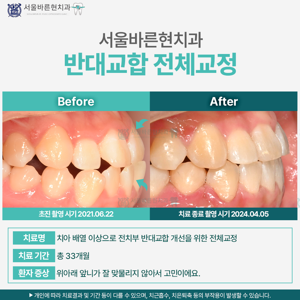 해운대반대교합교정