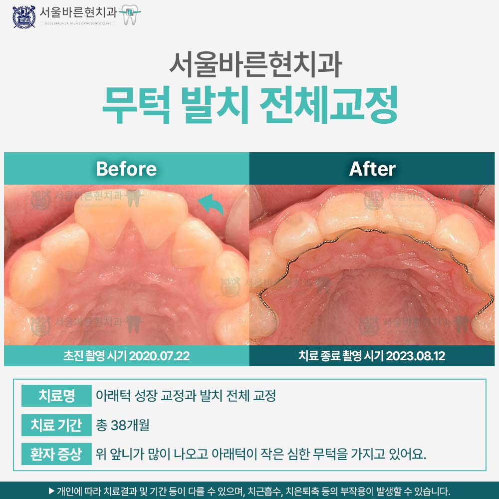 해운대소아교정
