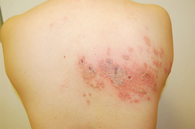 대상포진 초기증상