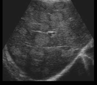 Liver metastases (전이성 간암)