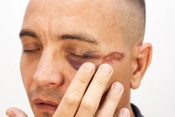 멍 자국 빨리 빼는 법 공개합니다.