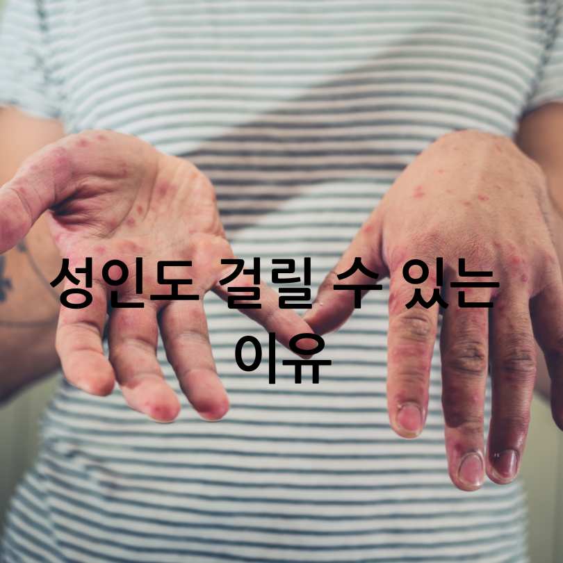 성인수족구 감염&amp;#44; 증상&amp;#44;원인&amp;#44; 경험담까지