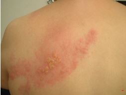 대상포진에_좋은음식