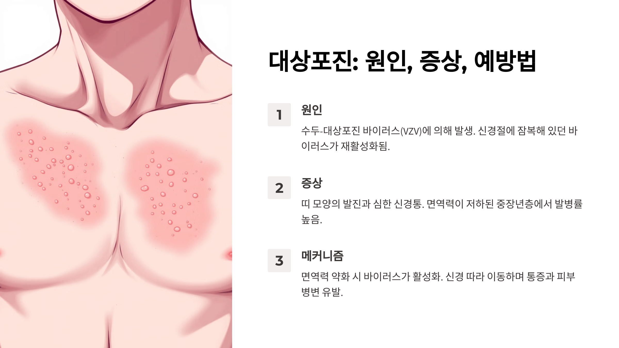 대상포진(헤르페스 바이러스) 원인, 증상, 예방법