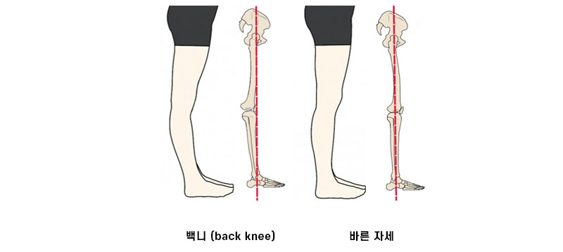 백니와 바른 자세 비교