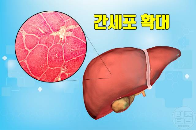 우루사 효능 간영양제 udca 효과 간세포보호