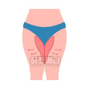 쯔쯔가무시 물린자국