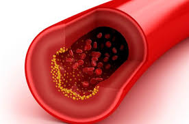 콜레스테롤 낮추는 방법 10가지