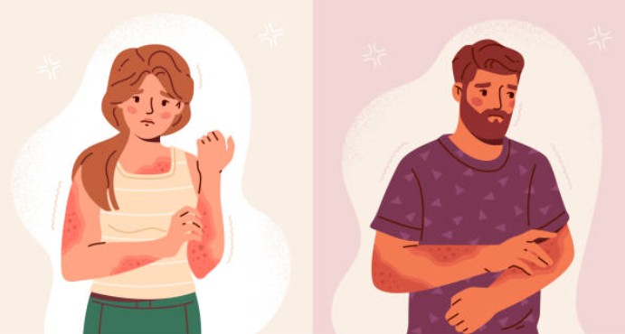 아토피 자가진단과 관리법 (증상체크, 병원진단, 관리)