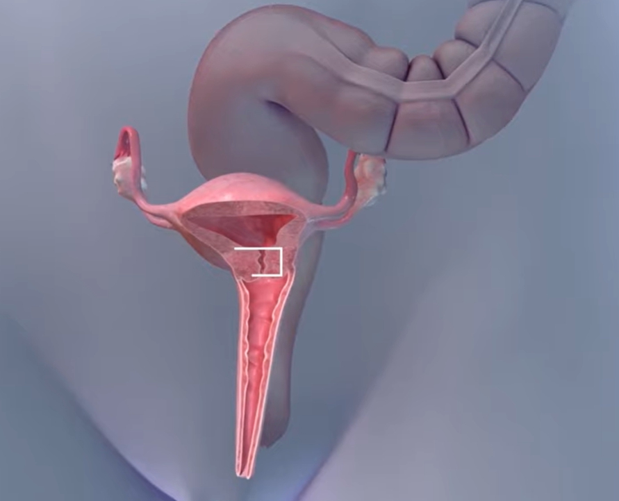 클라미디아 감염 경로