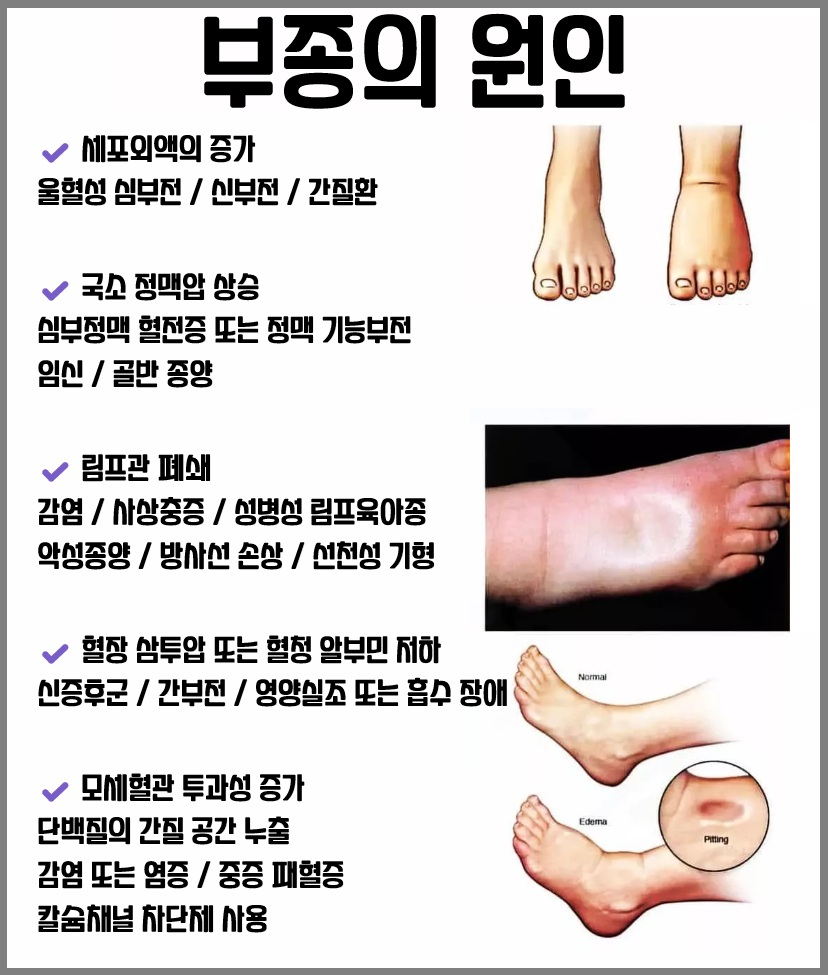 부종의 원인
