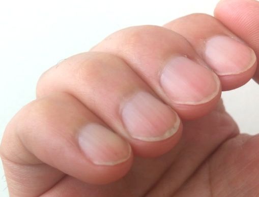 손톱 세로줄 무늬