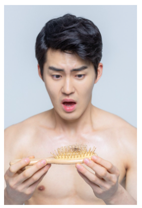 2023년 모발이식 가격 정리