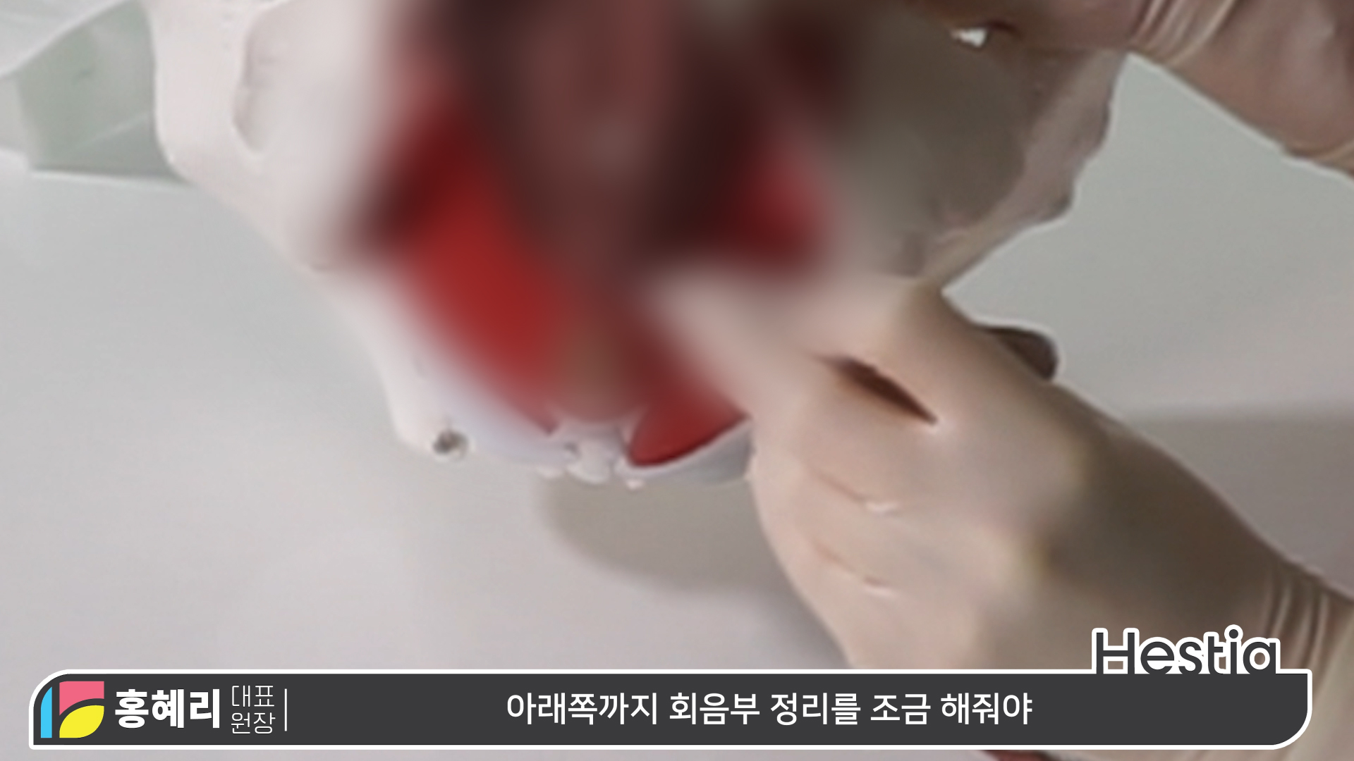 소음순성형수술 과정 대.공.개 ※수술 시물레이션 포함!