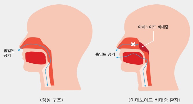 Enlarged Adenoids